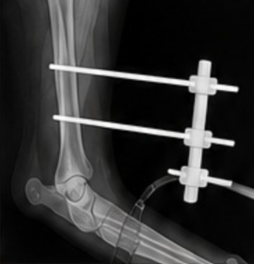 Radiografía fijación externa