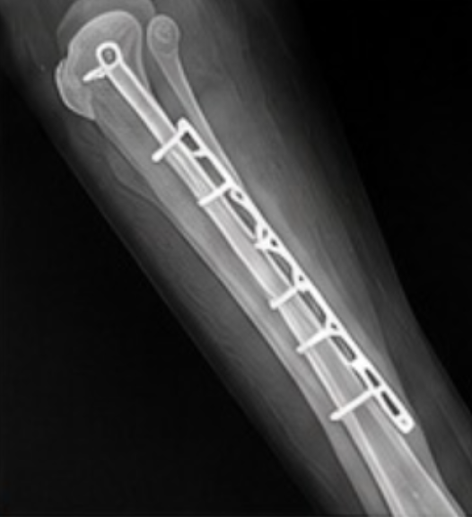 Radiografía osteosíntesis con placa